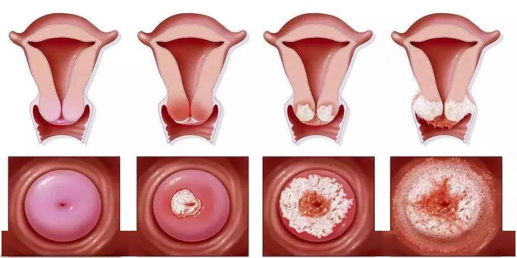 宫颈癌的早期一般会有3种症状,女性可以了解一下.