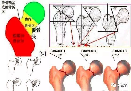 期较大,约20-30°,成年为12-15°,内,外八字步态者前倾角过大或过小