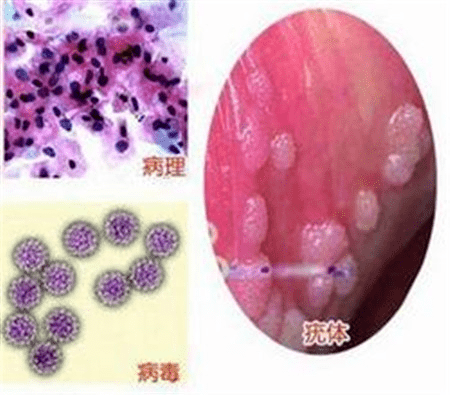 常见问题q1:尖锐湿疣是怎么感染的的?