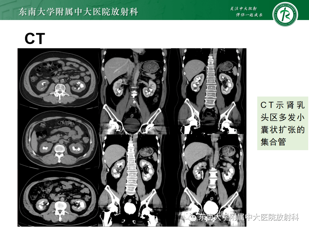 髓质海绵肾影像表现