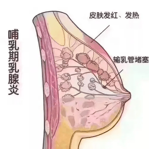 化脓性感染,是乳腺管内和周围结缔组织炎症,多发生于产后哺乳期的妇女
