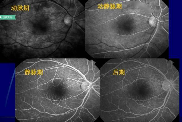 【图文】眼底荧光血管造影_训练_视觉_康复