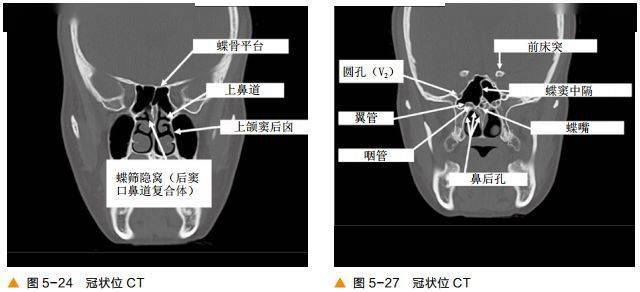 颅底及鼻窦ct轴冠矢解剖