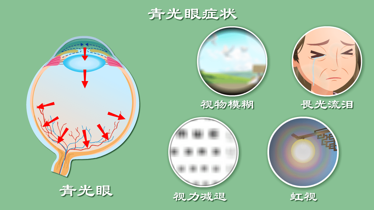 细数第二大致盲眼病—青光眼致盲前啥征兆_眼睛_患者_症状