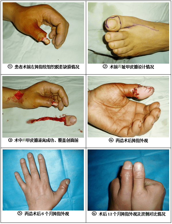 拇指末节脱套伤全形再造(刘刚义主任10年前手术成果)典型病例-1.