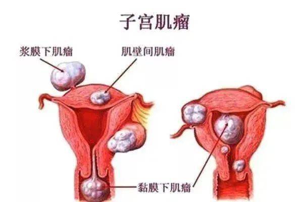 占据了整个子宫和阴道,导致直肠被压迫引起便秘,而肌瘤后壁感染严重