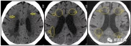 颅脑mr脑白质高信号是缺血灶吗?_疏松_病变_血管