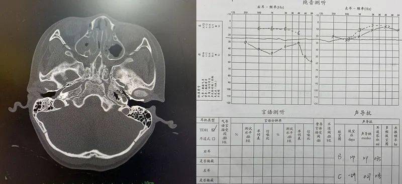 粗心爸妈8岁藏族女孩鼻堵多年未干预导致耳聋鼓膜置管挽回听力