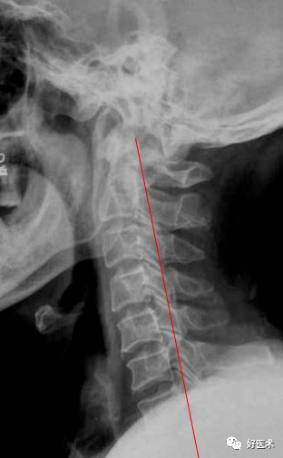 颈椎退变性滑脱(颈椎不稳)的测量:线移位-过伸位某一椎体后线后移