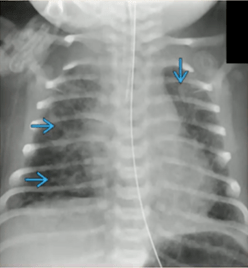 读完此文,终于会看儿童胸片了!_新生儿_阴影_气管