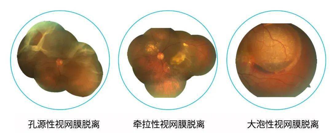 眼前有黑影当心视网膜脱离找上你