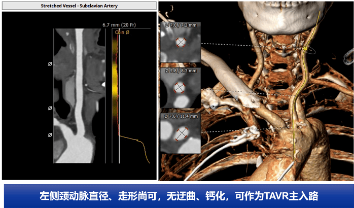 未见明显钙化斑块,双侧腹主动脉-髂动脉-股动脉走形稍迂曲,管壁多发非