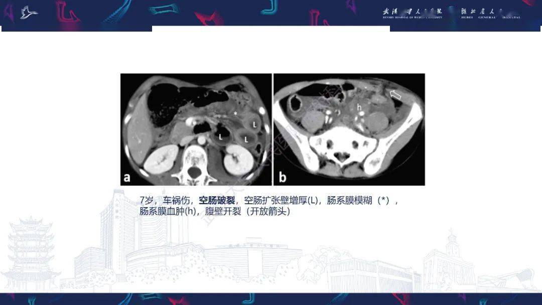 胃肠道穿孔ct诊断