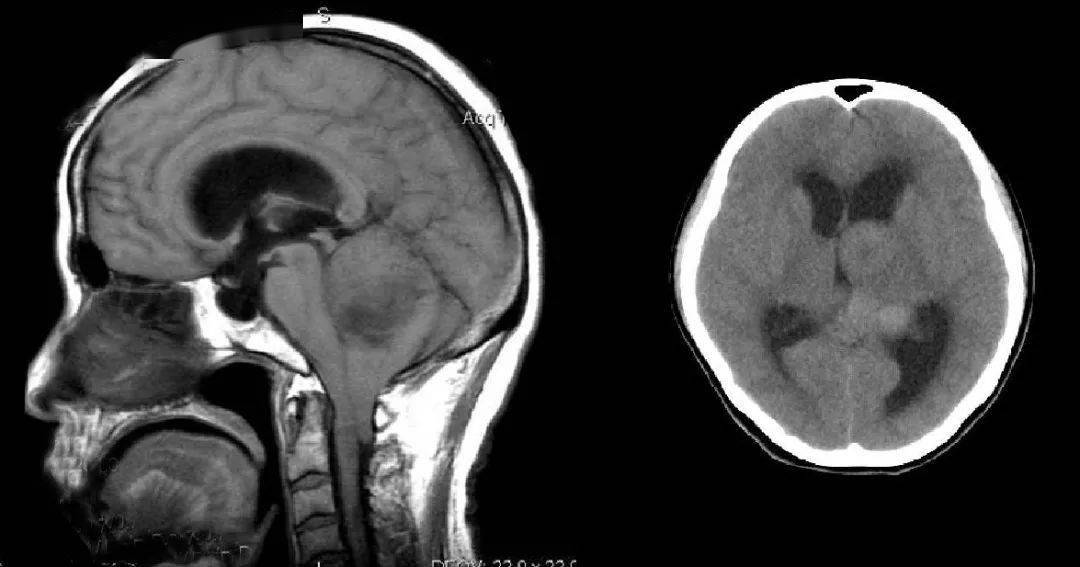 脑水肿脑积水的分类及影像表现一文归纳