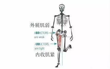 外展肌弱,走路时骨盆无法保持水平线如图,左腿那边的骨盆就会更低掉