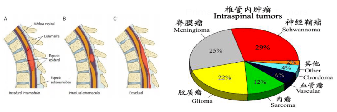 74髓内肿瘤:室管膜瘤,星形细胞瘤及胶质母细胞瘤等,占椎管内肿瘤的5