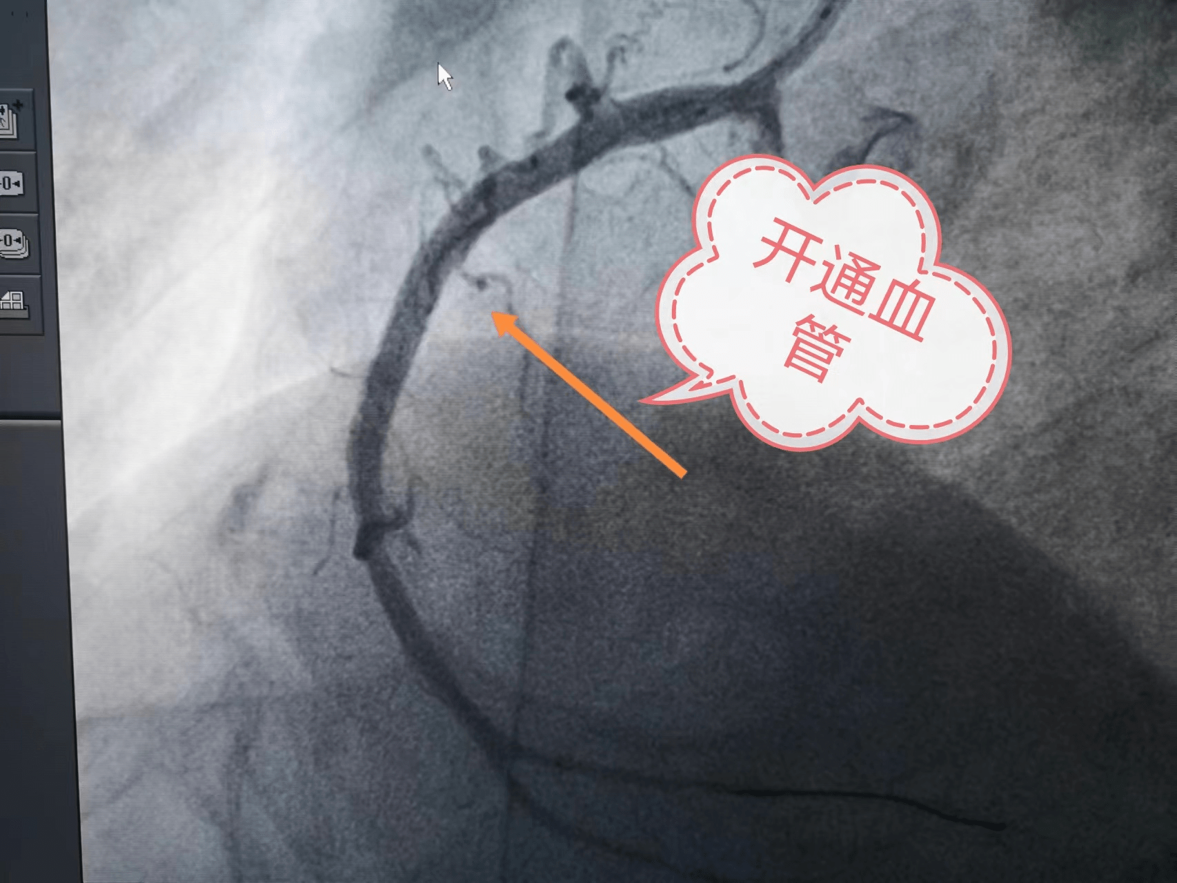 医生建议心脏造影患者拒绝1月后突发心肌梗死差点送命