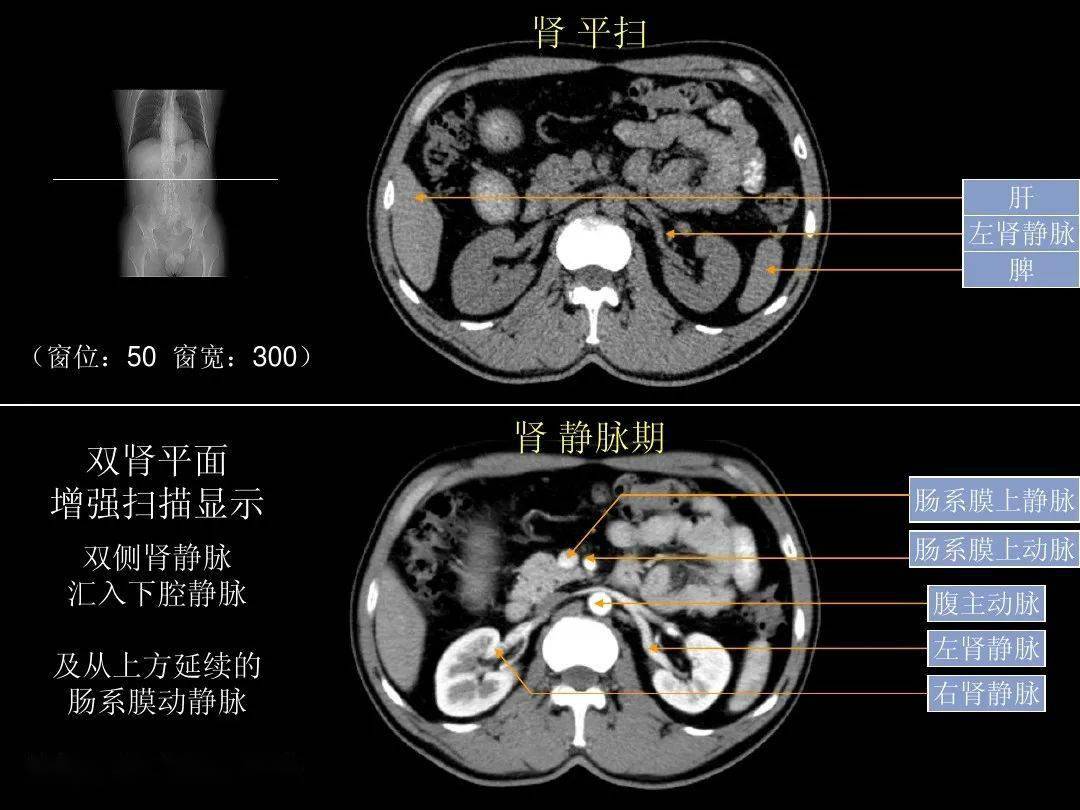 超细的腹部ct入门精美解剖图谱_图像_血管_器官