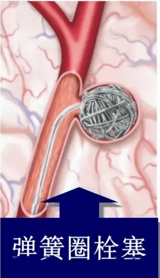 头痛揪出动脉瘤 弹簧栓塞巧"拆弹"_贾栋_阿姨_手术