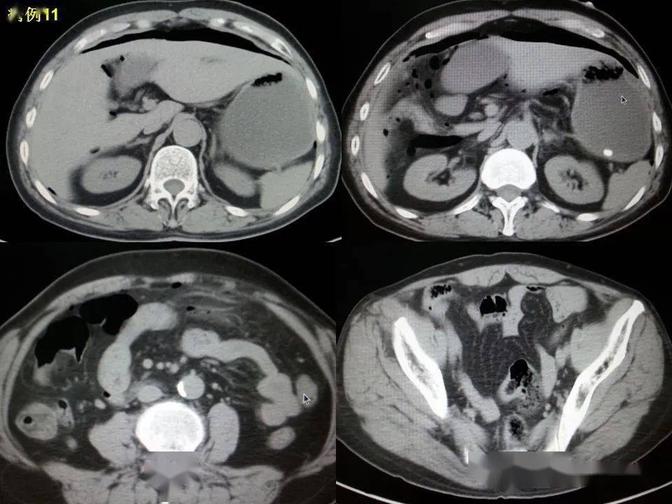 消化道穿孔ct影像大汇总看完印象深刻