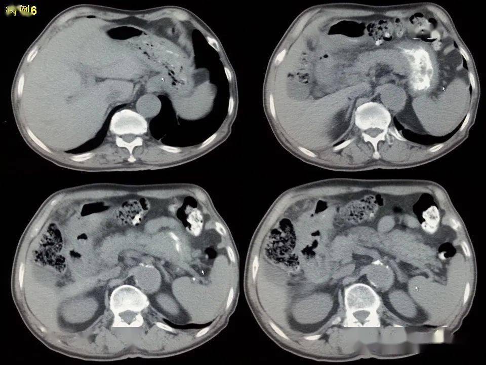 消化道穿孔ct影像大汇总看完印象深刻