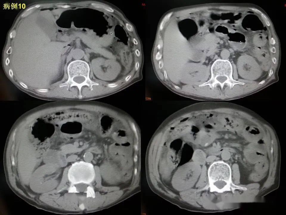 消化道穿孔ct影像大汇总看完印象深刻