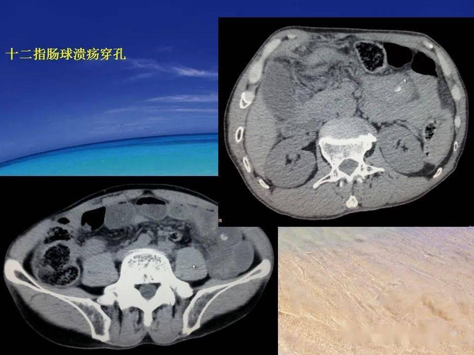 消化道穿孔ct影像大汇总看完印象深刻