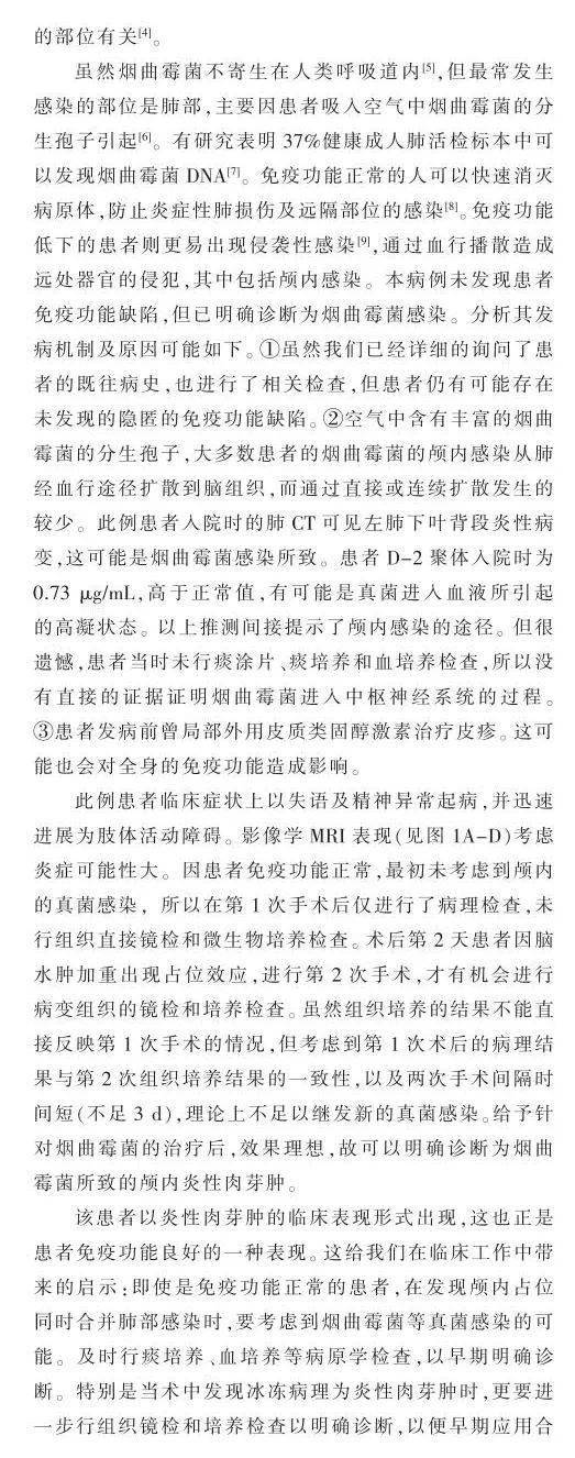 korsakoff综合征1例病例报告|肝豆状核变性合并下丘脑性肥胖1例论著