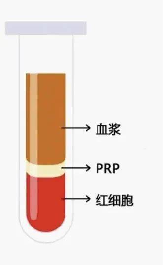 富血小板血浆(prp)作用机制prp中含高浓度的血小板,血小板激活后可