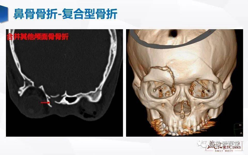 鼻骨正常ct解剖,变异与骨折_全网_影像_系统