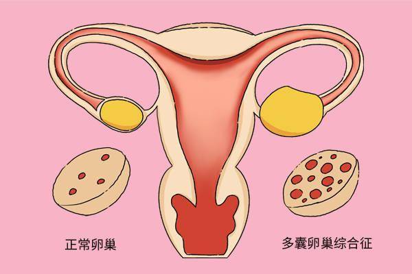 结婚6年没有孩子女子查出多囊卵巢综合征三个月后咋样了