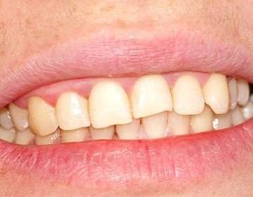 牙龈萎缩危害大,三个原因应当注意,第一个或许你还在犯_牙齿_口腔