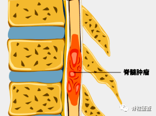 脊髓肿瘤 来自搜狐网