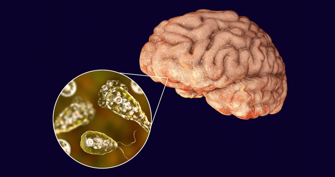 野泳有风险,小心被"食脑变形虫"钻入大脑_阿米巴_病例_报告