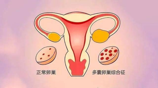 多囊卵巢，没你想象的可怕(图1)