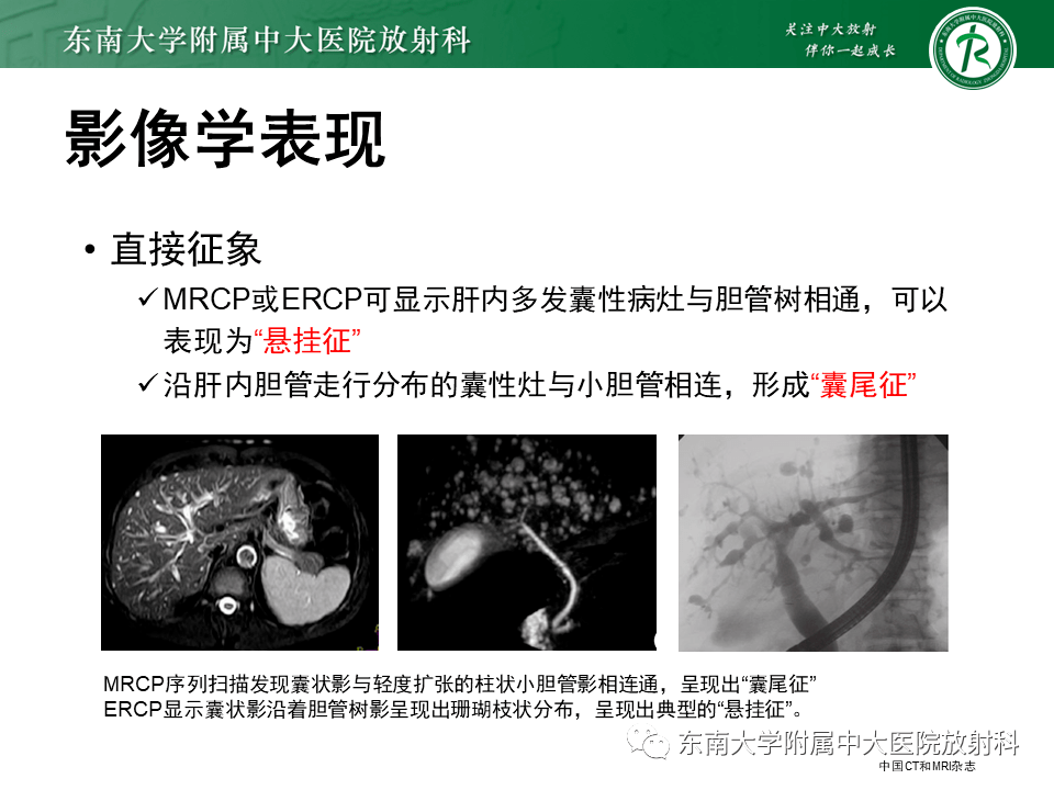 消化系统疾病——caroli综合征