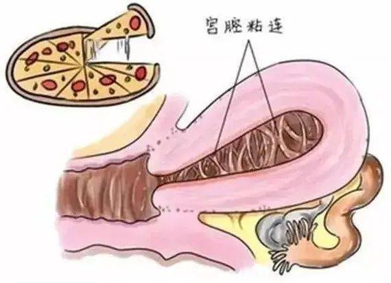 中国助孕机构（宫腔粘连致“久备不孕”，小镜子，大作用，一招解除不孕魔咒）