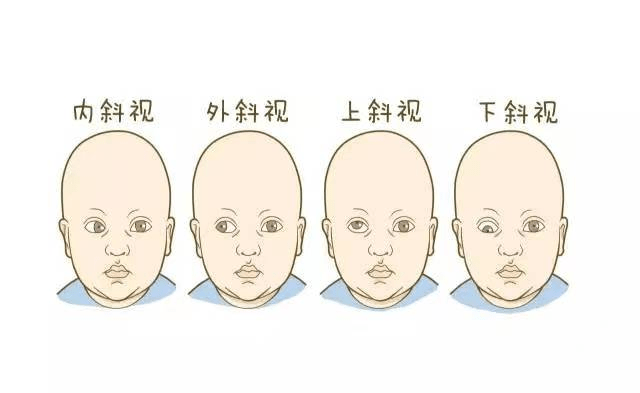 带你走进斜视的"视界"_孩子_问题_视觉