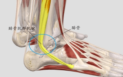 腓骨肌腱滑脱症不要再误诊为外踝扭伤了 患者 治疗 损伤