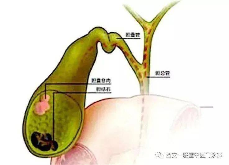 中医科普2390：胆囊炎、胆石症的中医诊断和治疗