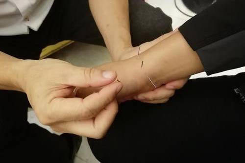 齐刺三针齐下,刺入较深,局部取穴用之较好;扬刺必须