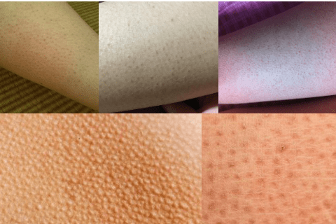 鸡皮肤用蜂蜜行吗(鸡皮肤最有效的方法)