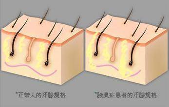 有腋臭影响交友恋爱这里有5个解决办法看看哪个适合您