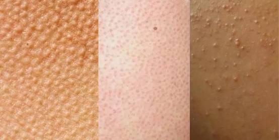 天生鸡皮肤怎么消除最有效的方法挽回少女肌3种有效方法