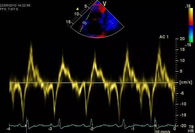 sam征超声心动图图片