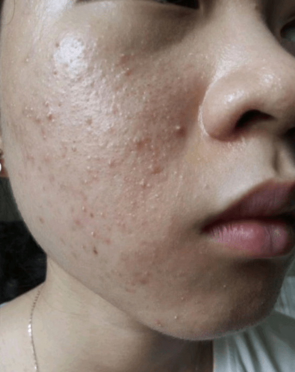 如果不喝的时候痘痘就又反复了,而且毕竟是药三分毒,我也不敢长期喝