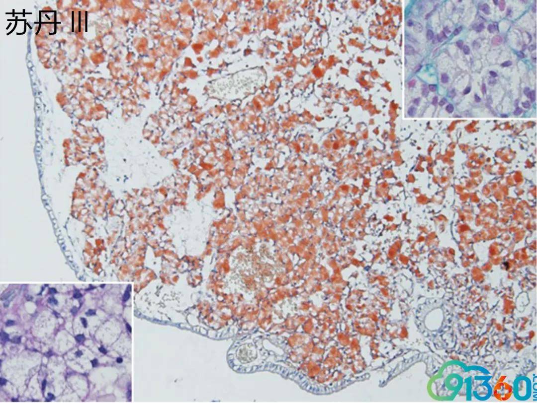 melan a,ca ix,胃泌素,5-羟色胺,cd68,inhibin-a,s-100 特殊染色:苏丹