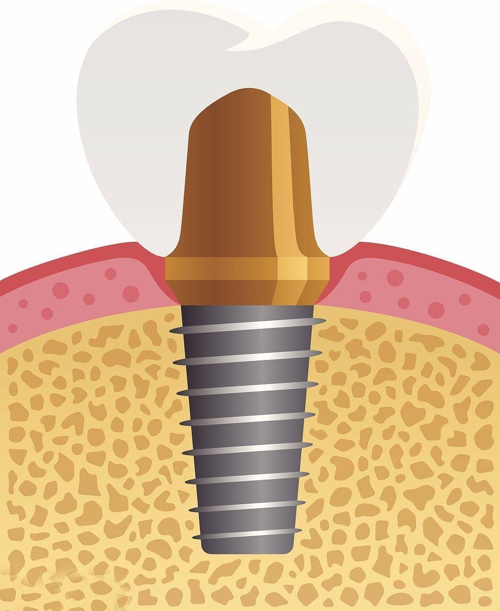 種植牙壽命短?這幾點術後維養你做到了嗎?_手機搜狐網
