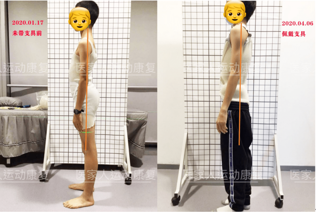 深圳脊柱侧弯案例13岁男孩侧弯27度支具线上康复三个月身体中线回正
