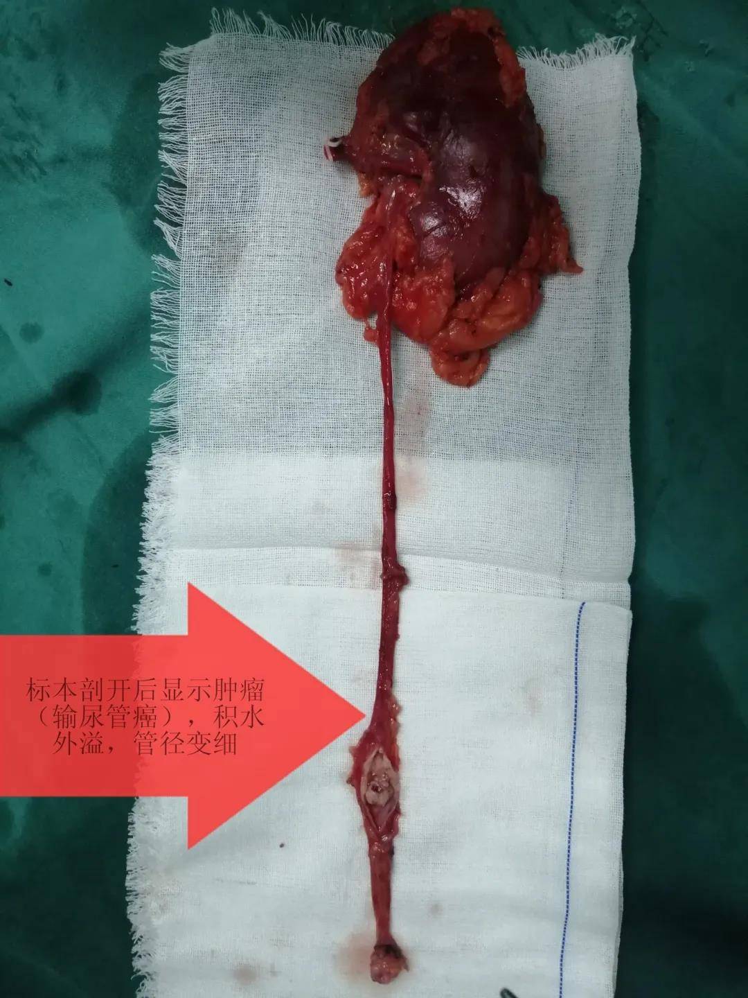 从医学角度讲,输尿管肿瘤的术前诊断存在一定的困难,往往需要医生凭借